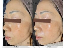 アン ビューティー(ann beauty)/施術1回【症例写真】