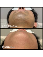 クリアボックス(Clear box)/【脱毛】