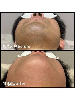 クリアボックス(Clear box)/【脱毛】