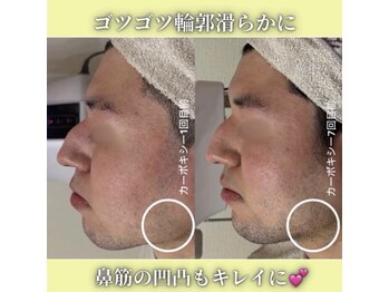 ハニエル(Haniel)/カーボキシー症例