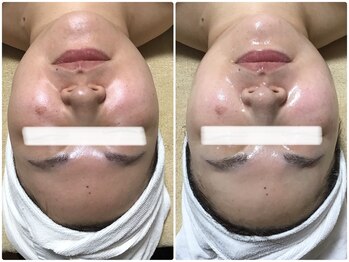 オージャス(OJAS)/30代のお客様/1回て艶玉肌に!