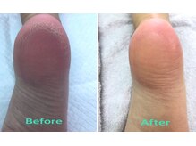 ノーラスリエン(Nolaslien)/ドイツ式角 フットケア 麻布十番