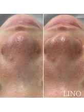 リノ(Lino)/毛穴スッキリ♪