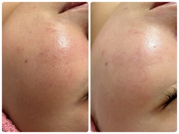 メルシア(merucia)/脱!頬毛穴★ララピール水光肌wax