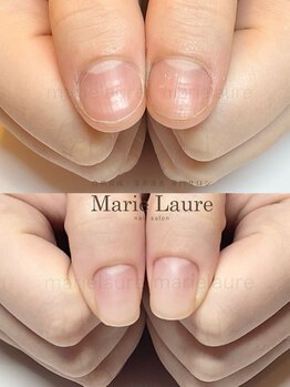 マリーロール 淀屋橋本店(Marie Laure)/自爪育成/深爪矯正/ネイルケア