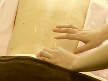 ブレア 元町/腰の鍼施術