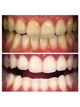 ルフレ(Reflet)/人と差をつけて白くしたい方へ☆