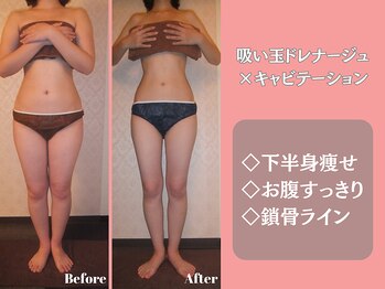 エステティックサロンティエリー/吸い玉×キャビ×ドレナージュ