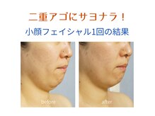 【レモンボトル】×【熟練マッサージ】で他店にはないこの結果！