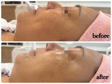 シルク(Cilk)/ハーブクリームピーリング