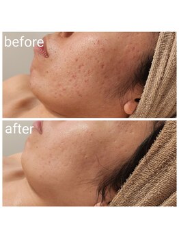 ルオント(LUONTO)/ハーブピーリング症例