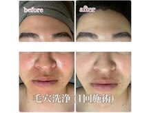 ミノア 熊本店(MINOA)/毛穴洗浄/毛穴/赤み