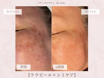 ビベル 八木店(Bebelle)/一気にエイジング悩み改善コース