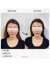 リベルタ鍼灸整骨院 なんば店(Liberta鍼灸整骨院)/韓国美容鍼って何？