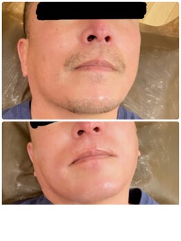 サロンドシェリ(salon de cheri)/Wax脱毛