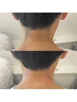 ニクス 札幌(NIX)/メンズうなじのWAX