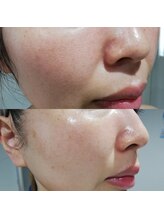 RiとBiのたまご/（フェイシャル）１ヶ月集中ケア