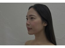 プランドール 京都店(PRENDRE)/小顔リフト　施術１回目→３回目