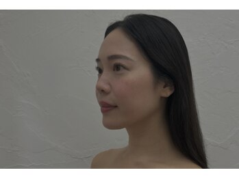プランドール 京都店(PRENDRE)/小顔リフト 施術1回目→3回目