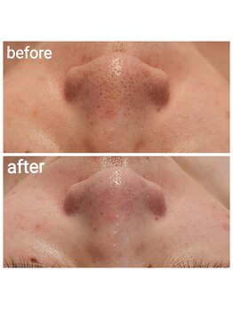 ルオント(LUONTO)/ゴッソリ毛穴ケア