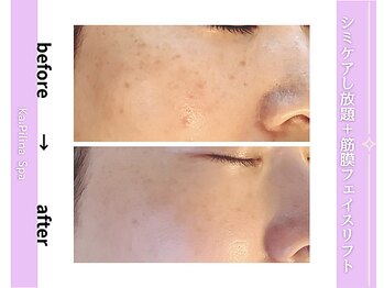 カピリナスパ(Ka.Pilina Spa)/シミケア6回目 before⇒after