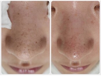 ウェルビーイング(well-being)/毛穴洗浄×ハーブピーリング