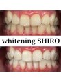 福岡ホワイトニングシロ 天神中洲店(福岡ホワイトニングSHIRO) 【美歯口ホワイトニング】before/after