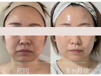 モンレーヴ/ひと回り小さい小顔に