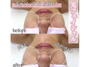 サロン(SALON)/光フェイシャル