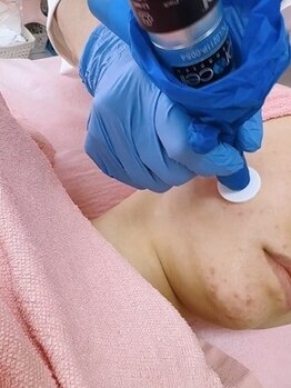 美キュートの写真/【幹細胞由来プロセルセラピーズ/毛穴エクストラクション】黒い毛穴やいちご鼻も素肌輝く毛穴レス肌へ☆