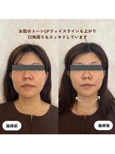 ウーマンビーヘルス(woman Be Health)/オーダーメイド美容鍼灸90分初回