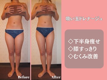 エステティックサロンティエリー/吸い玉ドレナージュ