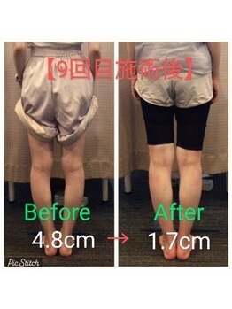 クシロ鍼灸整骨院/【O脚矯正】施術例