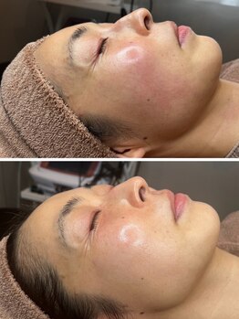 ホウレイ線・たるみ改善！予防ケア