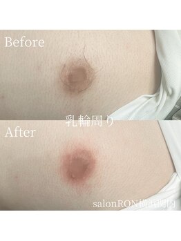サロンロン 横浜関内(SALON RON)/乳輪周り/美容電気脱毛