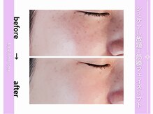 カピリナスパ(Ka.Pilina Spa)/シミケア2回目　before⇒after