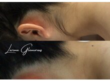 ラリマ グラマラス(Larima Glamorous)/毛穴レス脱毛