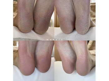 ◇フット角質ケア◇