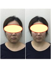 やち鍼灸院/小顔整体でフェイスラインアップ