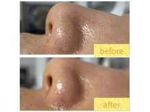 ラレコルト/ビフォーアフター