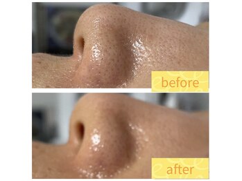 ラレコルト/ビフォーアフター