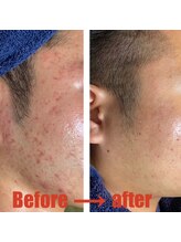 クイーン 熱海店(Queen)/男性の疲れによる肌荒れケア