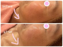 ヒメミ(Himemi)/ＢＢＬ光フェイシャル