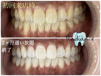 札幌セルフホワイトニング ラディアンス(Radiance)/1番人気ホワイトニング