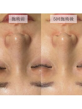 デジール(desir)/【フェイシャル】before/after