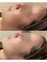 ハーブのほし/肌のキメが細かく水分量もアップ