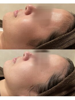 ハーブのほし/肌のキメが細かく水分量もアップ