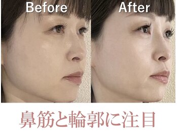 ラプリ 銀座店(Raplit)/隆鼻＋輪郭矯正40分10回