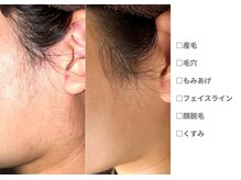 ピュアノア 垂水店/産毛脱毛　顔脱毛　神戸垂水明石