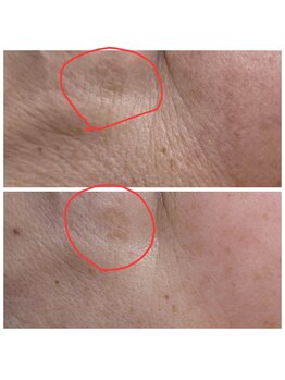 越前屋/シミケア3回終了